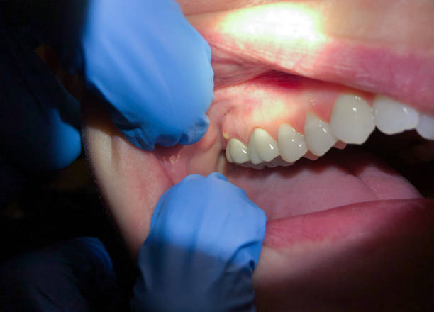 Best Emergency Care for Gum Disease in Wallace, FL